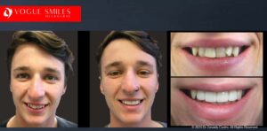 Crooked Teeth Before and After Gallery Melbourne CBD - Instantly Straighten Teeth - fix crooked teeth without braces