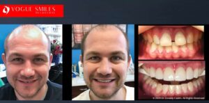Composite Bonding vs. Porcelain Veneers Melbourne – Which One Is Right for You?