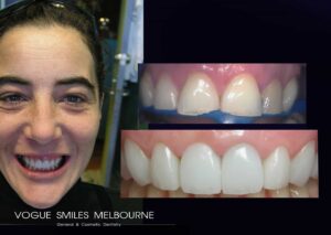 LUMINEERS VENEER versus TRADITIONAL PORCELAIN VENEER IN MELBOURNE