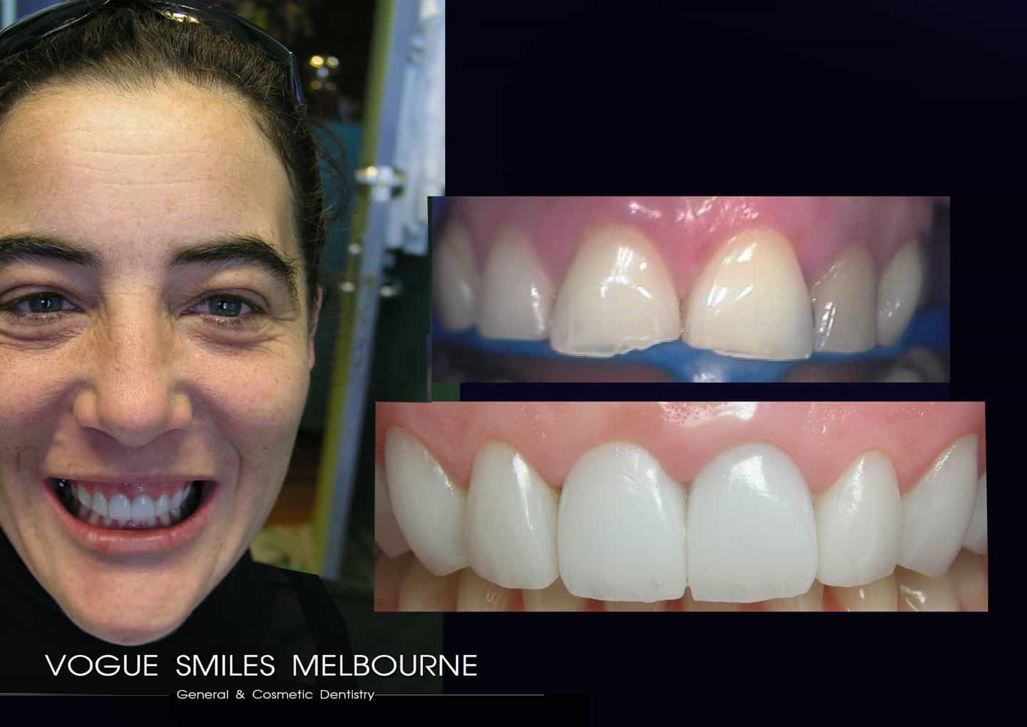 LUMINEERS VENEER versus TRADITIONAL PORCELAIN VENEER IN MELBOURNE