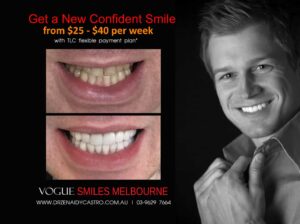 Complete Guide to At-Home Teeth Whitening in Melbourne CBD & Noble Park North