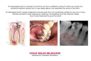 Dental Abscess Treatment Melbourne CBD& Noble Park North