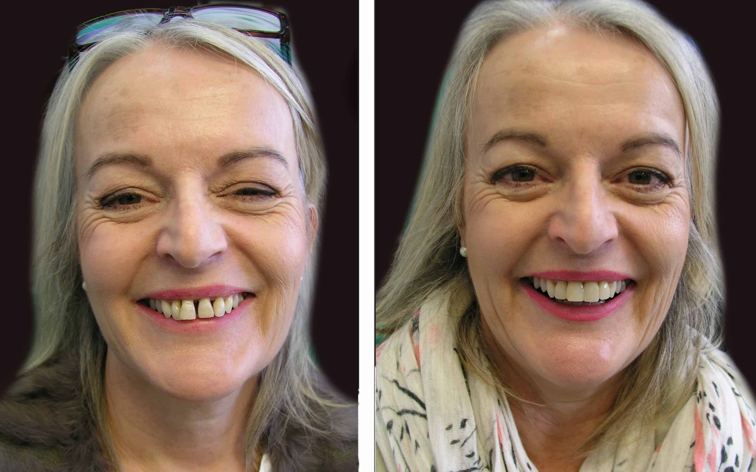 Best, Most affordable Cosmetic Dentist near me in Noble Park North, Springvale, Dandenong