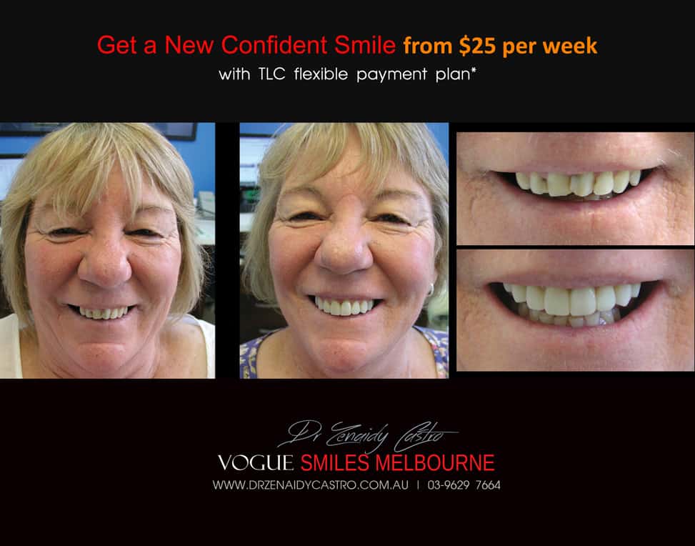 Affordable-Cheap-Cosmetic-Smile-Makeover