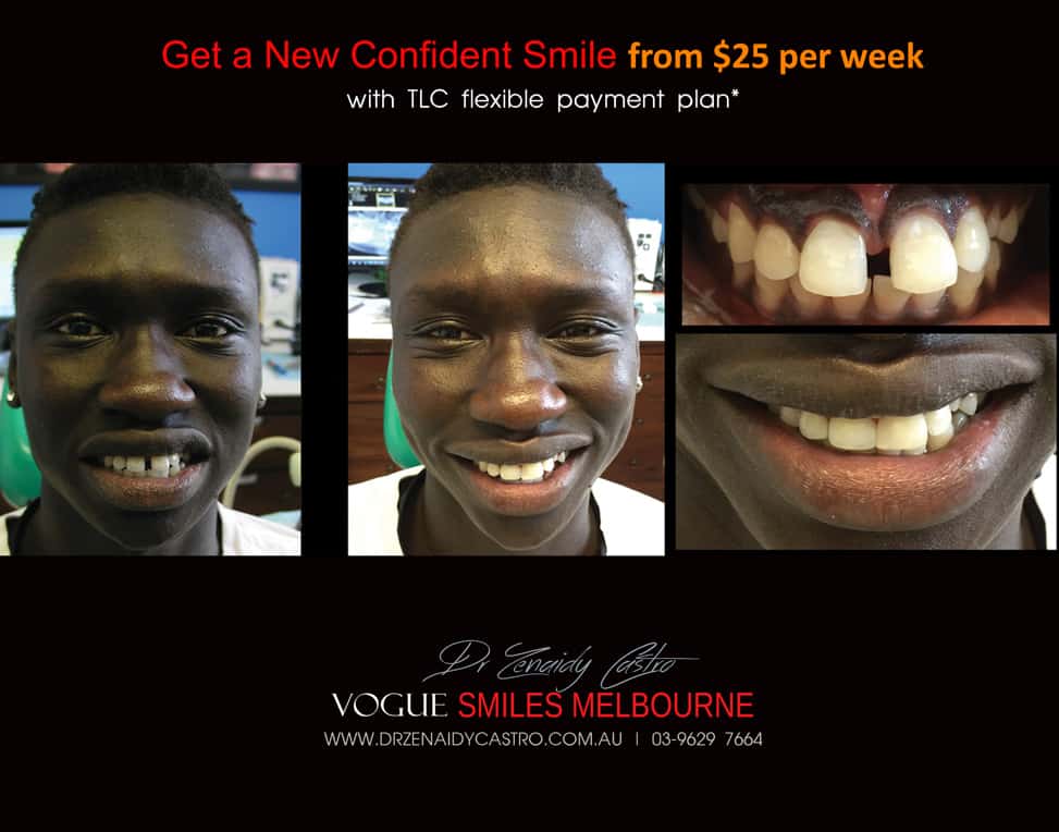 Affordable-Cheap-Cosmetic-Smile-Makeover