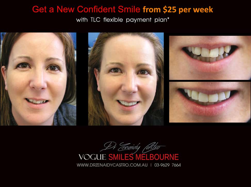 Affordable-Cheap-Cosmetic-Smile-Makeover