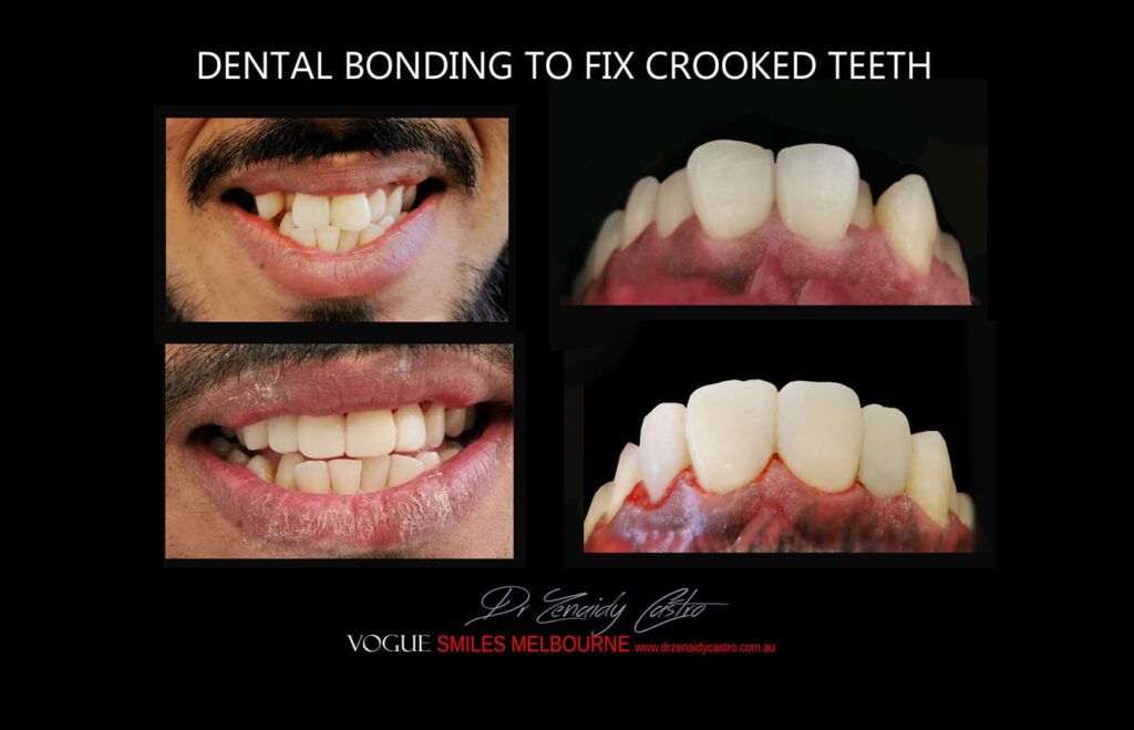 Affordable-Cheap-Cosmetic-Smile-Makeover