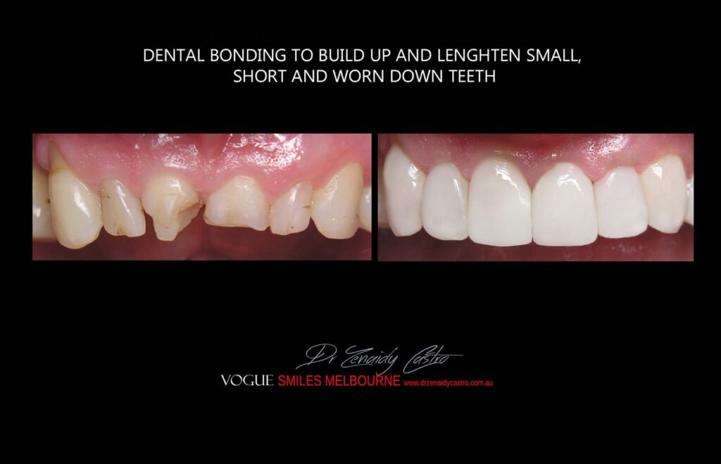 Affordable-Cheap-Cosmetic-Smile-Makeover
