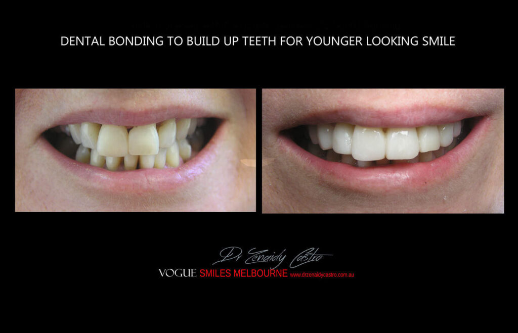 Affordable-Cheap-Cosmetic-Smile-Makeover