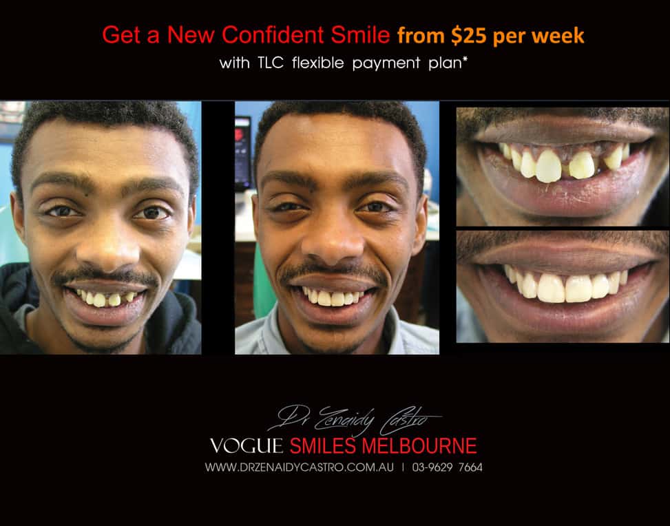 Affordable-Cheap-Cosmetic-Smile-Makeover