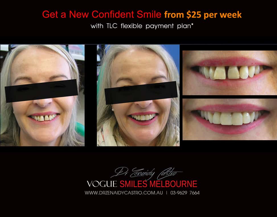 Affordable-Cheap-Cosmetic-Smile-Makeover