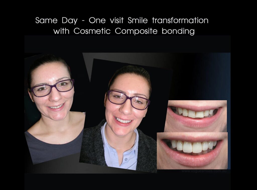 Affordable-Cheap-Cosmetic-Smile-Makeover