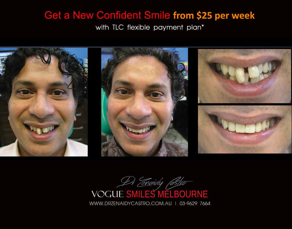 Affordable-Cheap-Cosmetic-Smile-Makeover