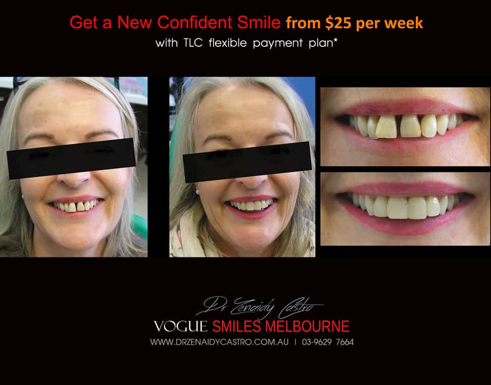 Affordable-Cheap-Cosmetic-Smile-Makeover