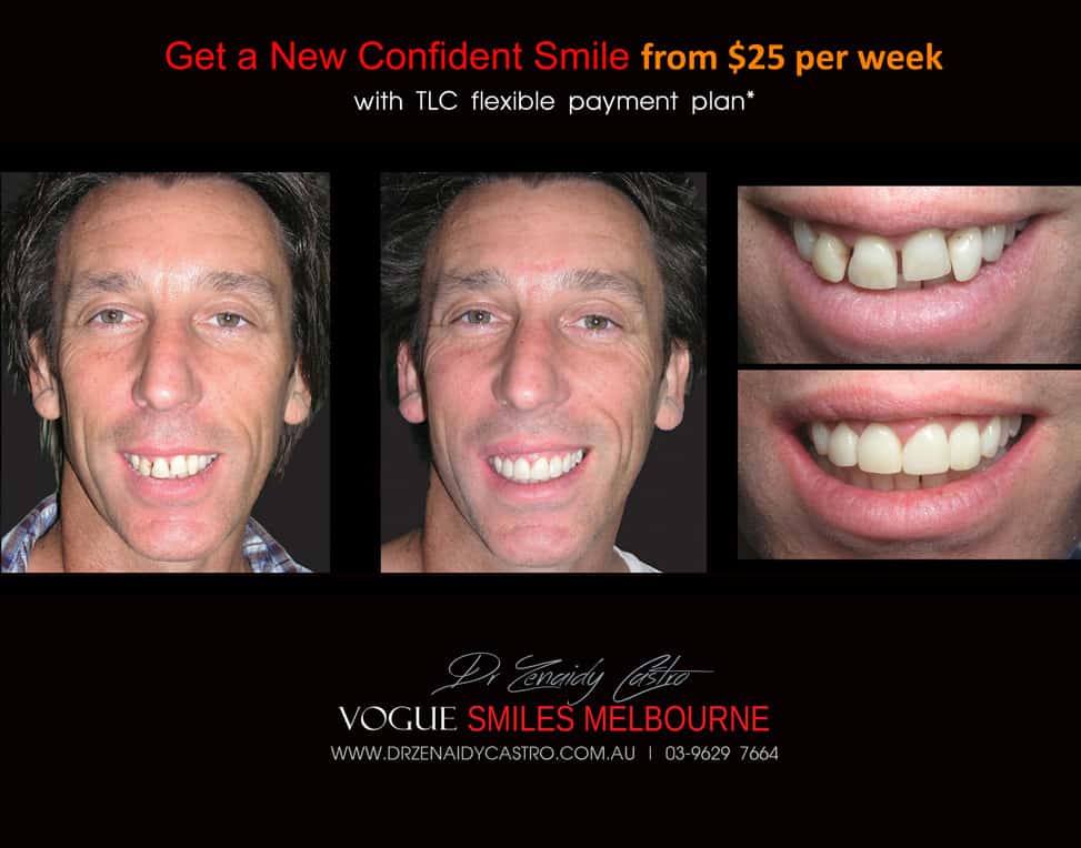 Affordable-Cheap-Cosmetic-Smile-Makeover