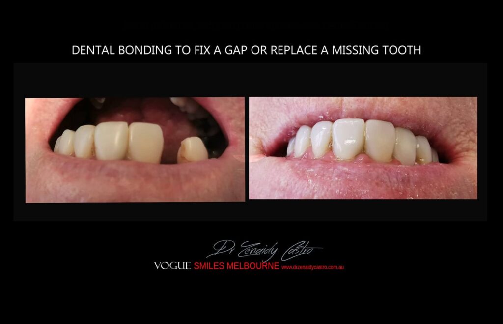 Affordable-Cheap-Cosmetic-Smile-Makeover