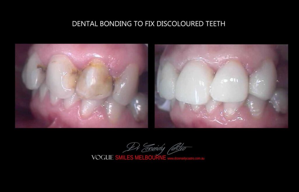 Affordable-Cheap-Cosmetic-Smile-Makeover