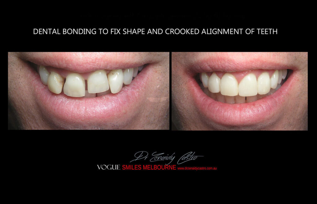 Affordable-Cheap-Cosmetic-Smile-Makeover