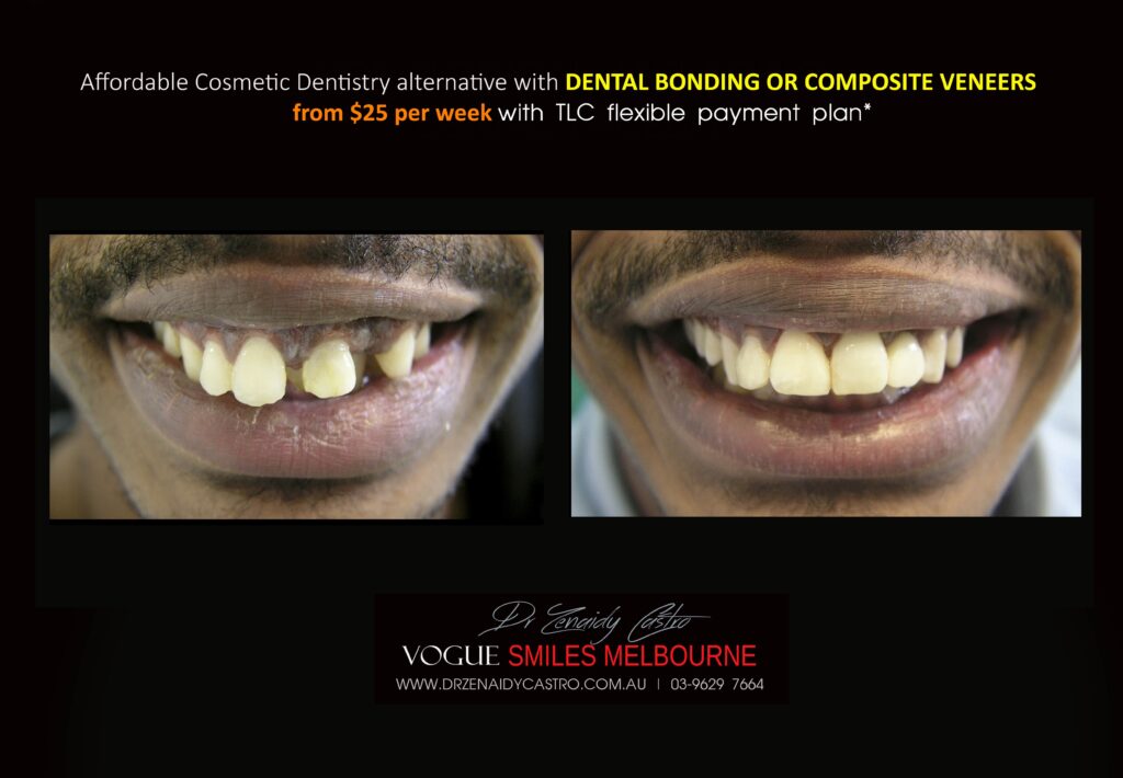 Affordable-Cheap-Cosmetic-Smile-Makeover
