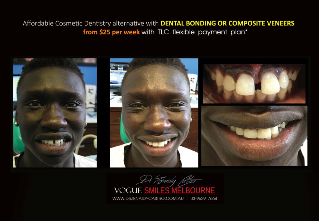 Affordable-Cheap-Cosmetic-Smile-Makeover