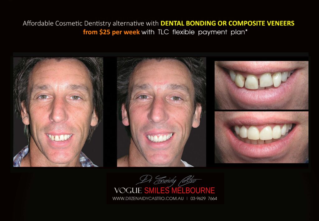 Affordable-Cheap-Cosmetic-Smile-Makeover