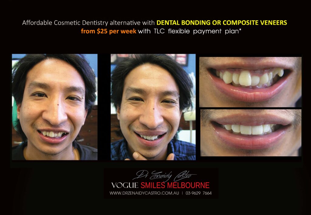 Affordable-Cheap-Cosmetic-Smile-Makeover