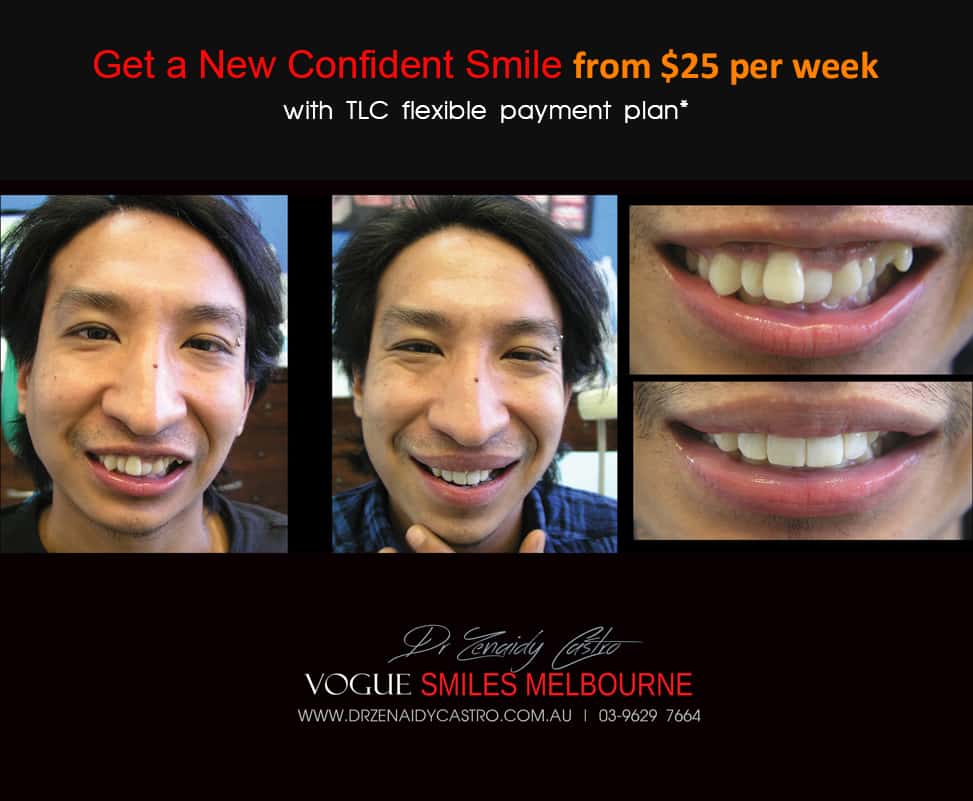 Affordable-Cheap-Cosmetic-Smile-Makeover