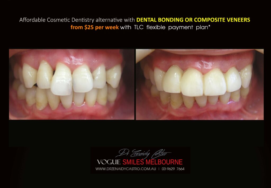 Affordable-Cheap-Cosmetic-Smile-Makeover
