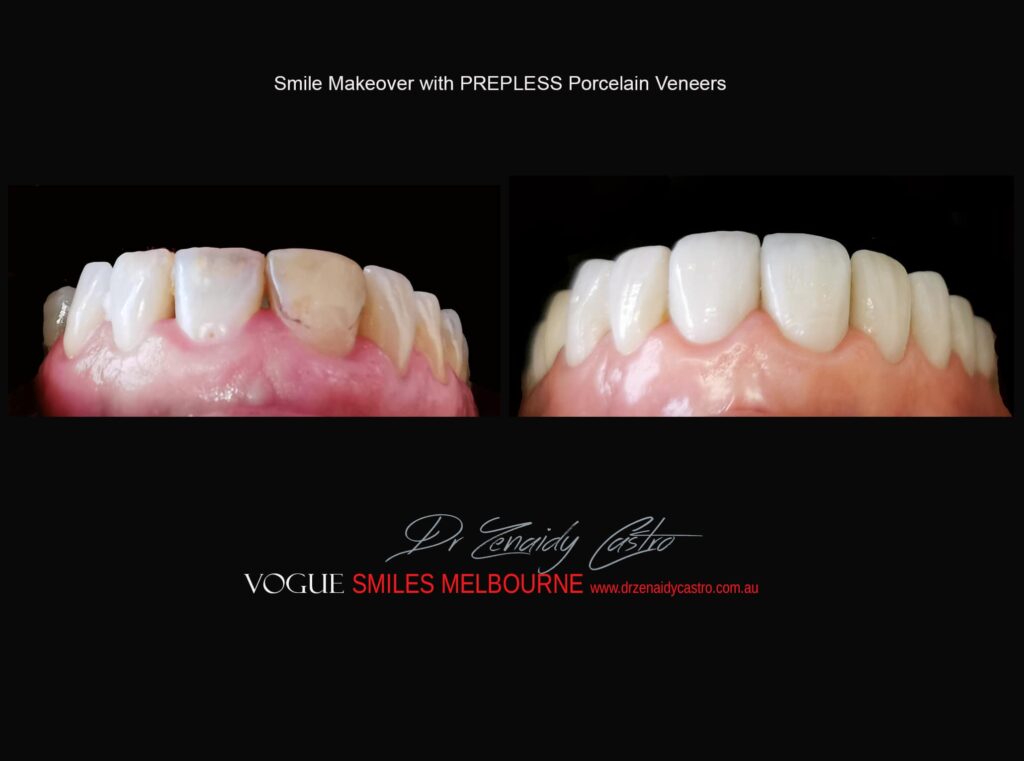 Affordable-Cheap-Cosmetic-Smile-Makeover