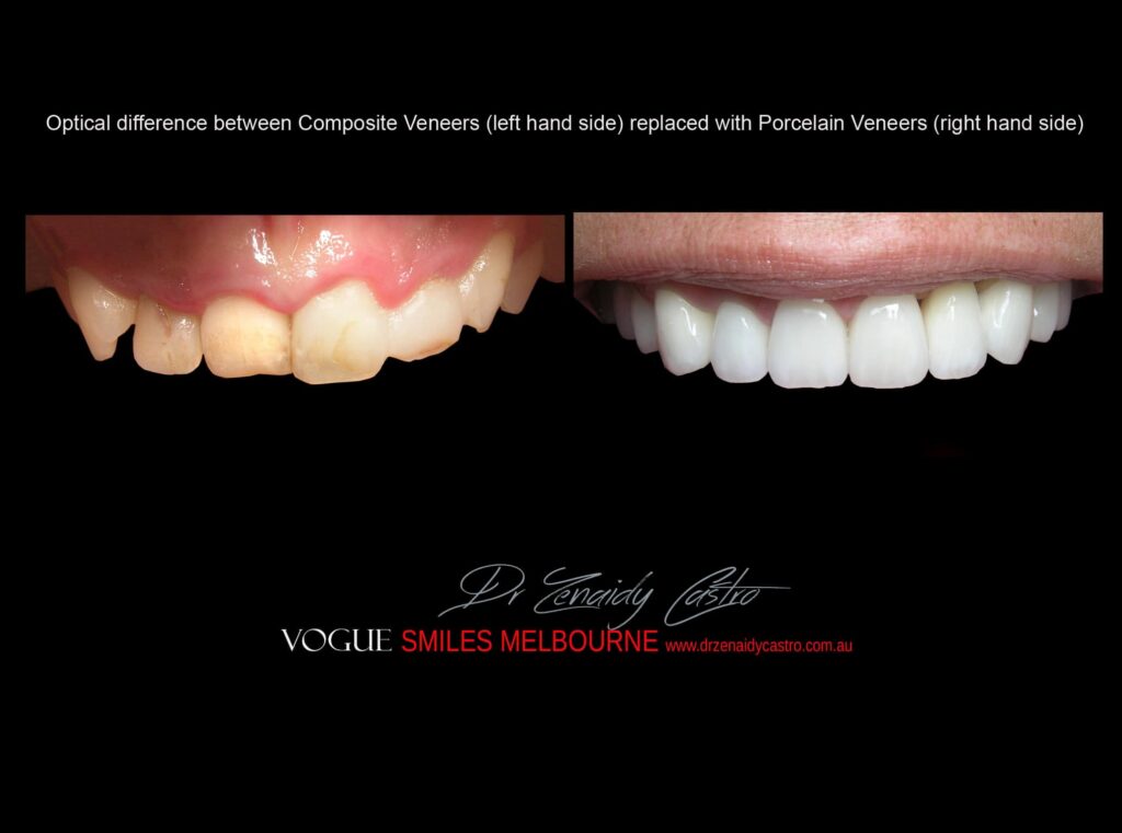 Affordable-Cheap-Cosmetic-Smile-Makeover