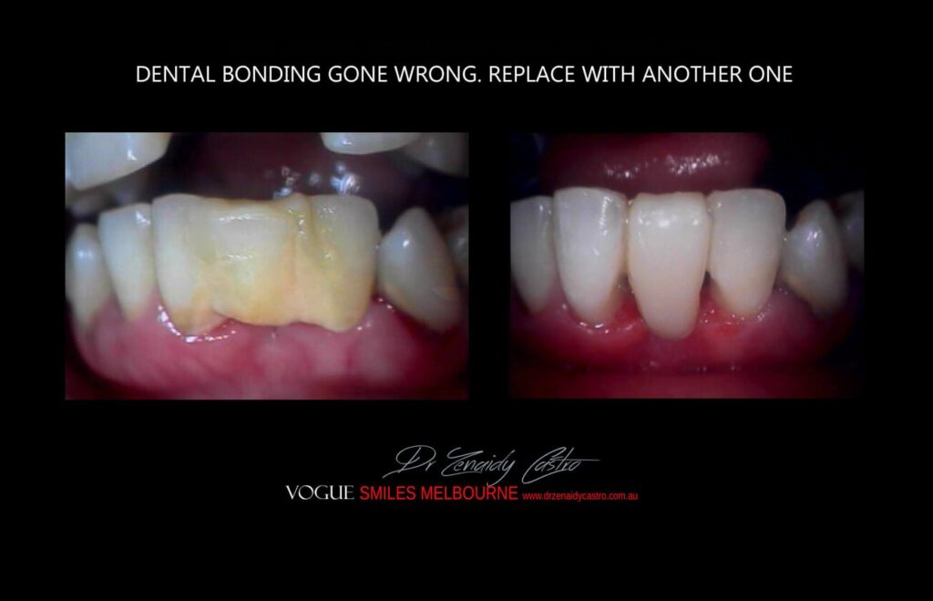 Affordable-Cheap-Cosmetic-Smile-Makeover