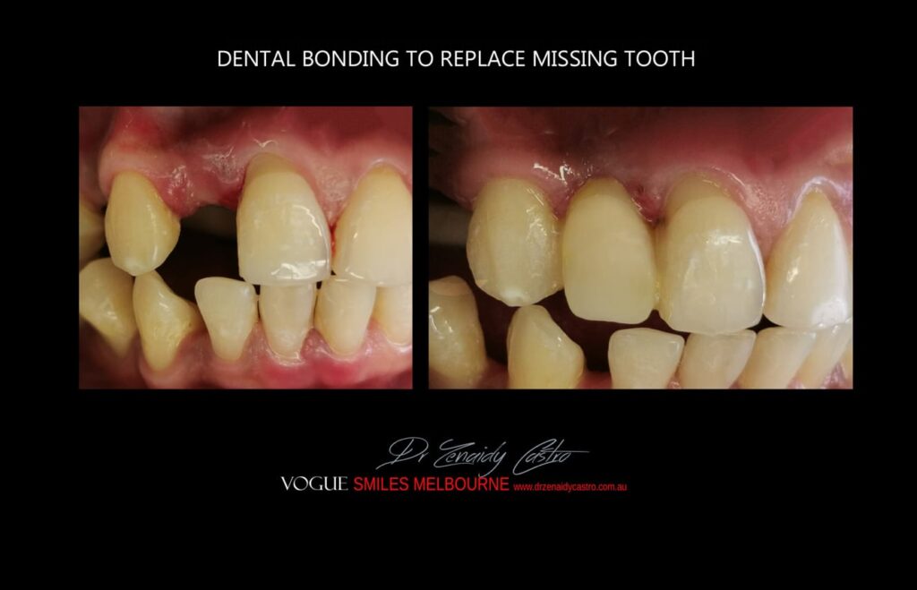 Affordable-Cheap-Cosmetic-Smile-Makeover
