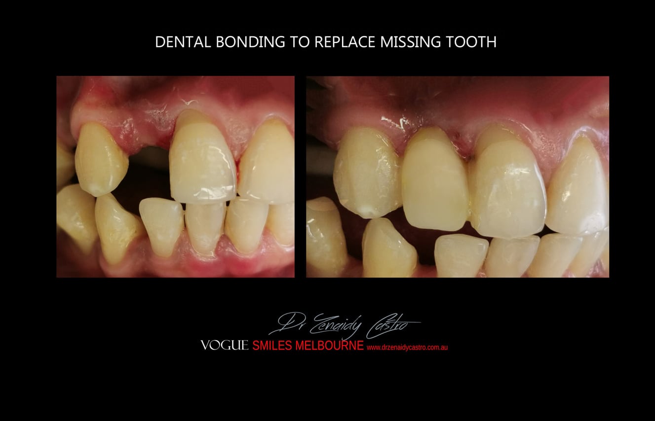 Transitional Smile Makeovers Before & After Dandenong North Transitional Smile Makeovers Before & After Dandenong North Transitional Smile Makeovers Before & After Dandenong North Transitional Smile Makeovers Before & After Dandenong North