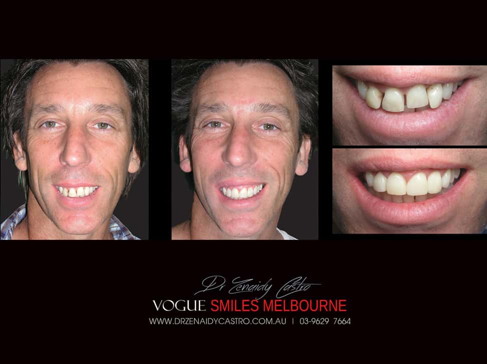 Affordable-Cheap-Cosmetic-Smile-Makeover