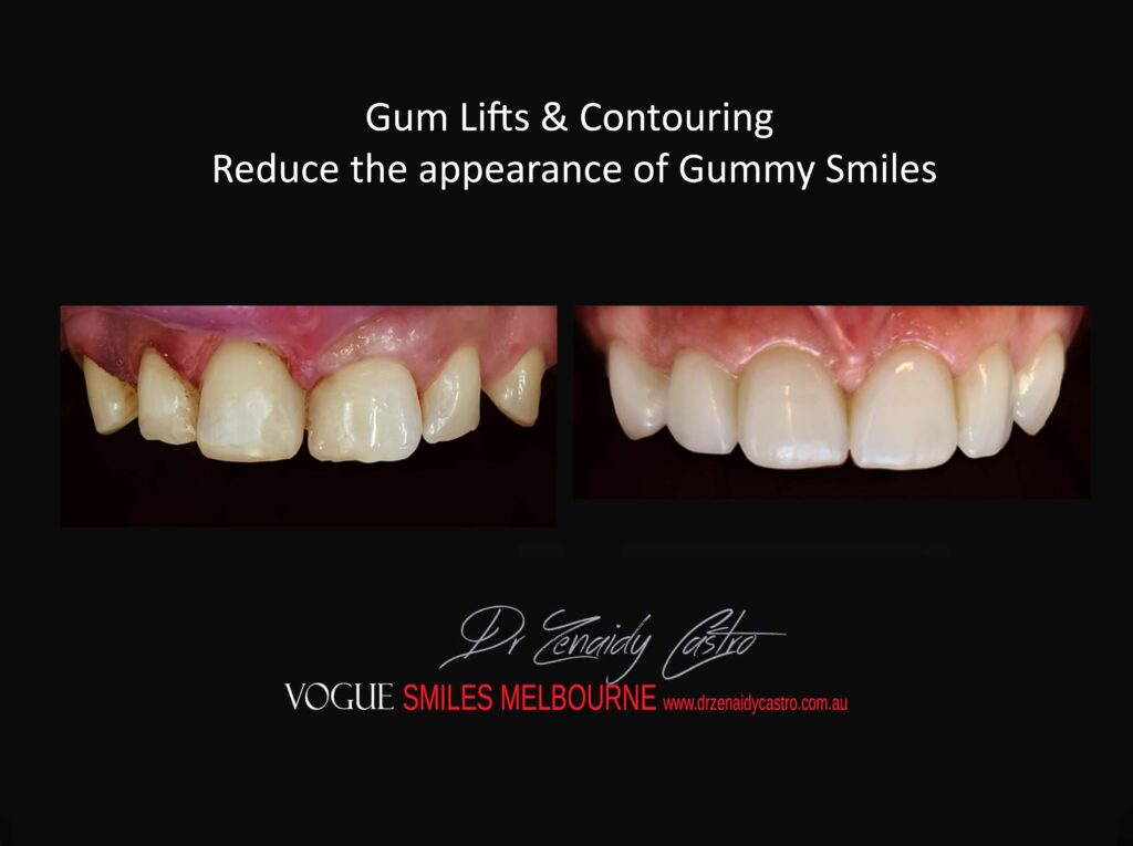Affordable-Cheap-Cosmetic-Smile-Makeover