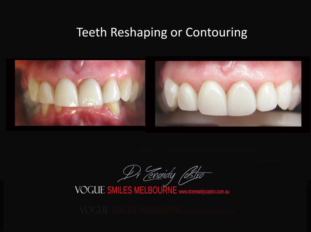 Affordable-Cheap-Cosmetic-Smile-Makeover