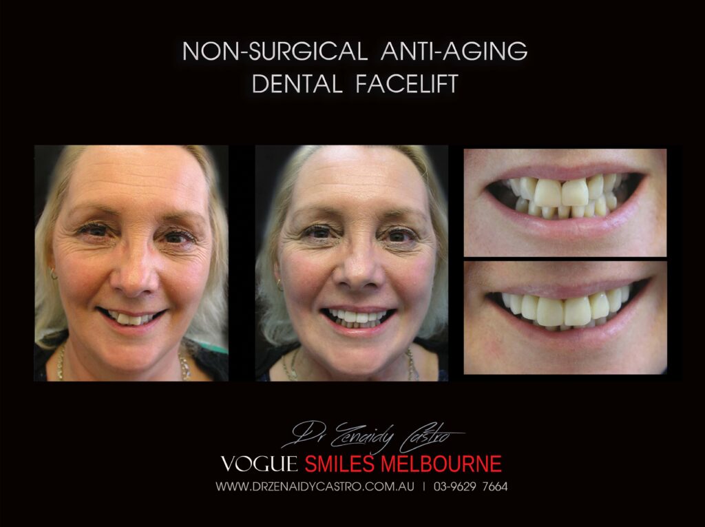 Affordable-Cheap-Cosmetic-Smile-Makeover