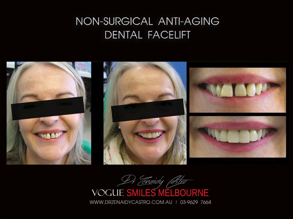Affordable-Cheap-Cosmetic-Smile-Makeover