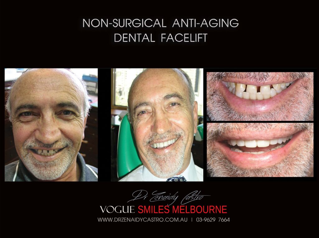 Affordable-Cheap-Cosmetic-Smile-Makeover