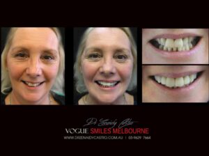 Is there a cheaper alternative to Porcelain veneers?, Cheapest Cosmetic Dentist Near Me for Smile Makeovers, Cosmetic Dentistry in Noble Park North, Affordable Smile Makeover Dentistry in Noble Park North. General Dentist Noble Park North- Best Dentist in Noble Park North - Best Dental Clinic in Noble Park North, Best Cosmetic Dentist in Noble Park North. Serving surrounding suburbs Dandenong North, Mulgrave, Springvale, Springvale South, Noble Park, Rowville, Wheelers Hill, Keysborough, and Endeavour Hills, Mulgrave, Glen Waverly