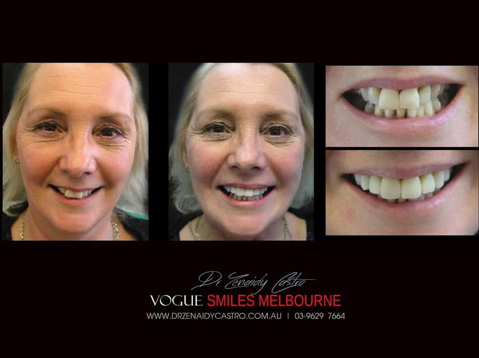 Affordable-Cheap-Cosmetic-Smile-Makeover