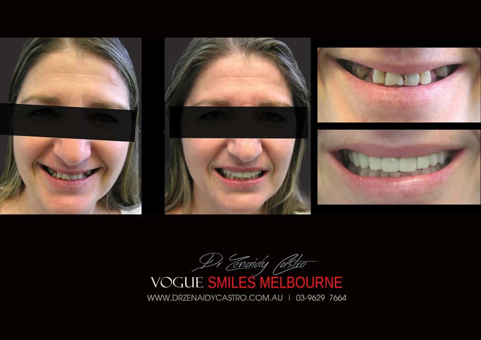 Affordable-Cheap-Cosmetic-Smile-Makeover