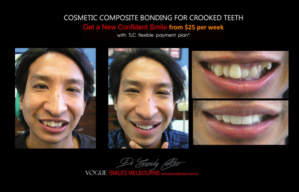 Affordable-Cheap-Cosmetic-Smile-Makeover