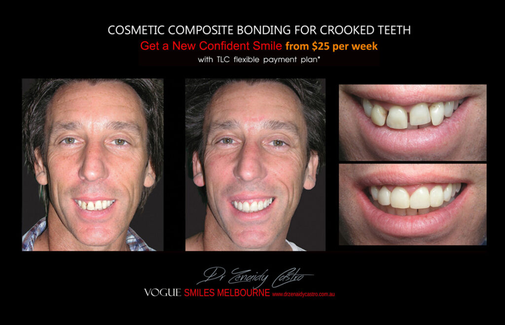 Affordable-Cheap-Cosmetic-Smile-Makeover