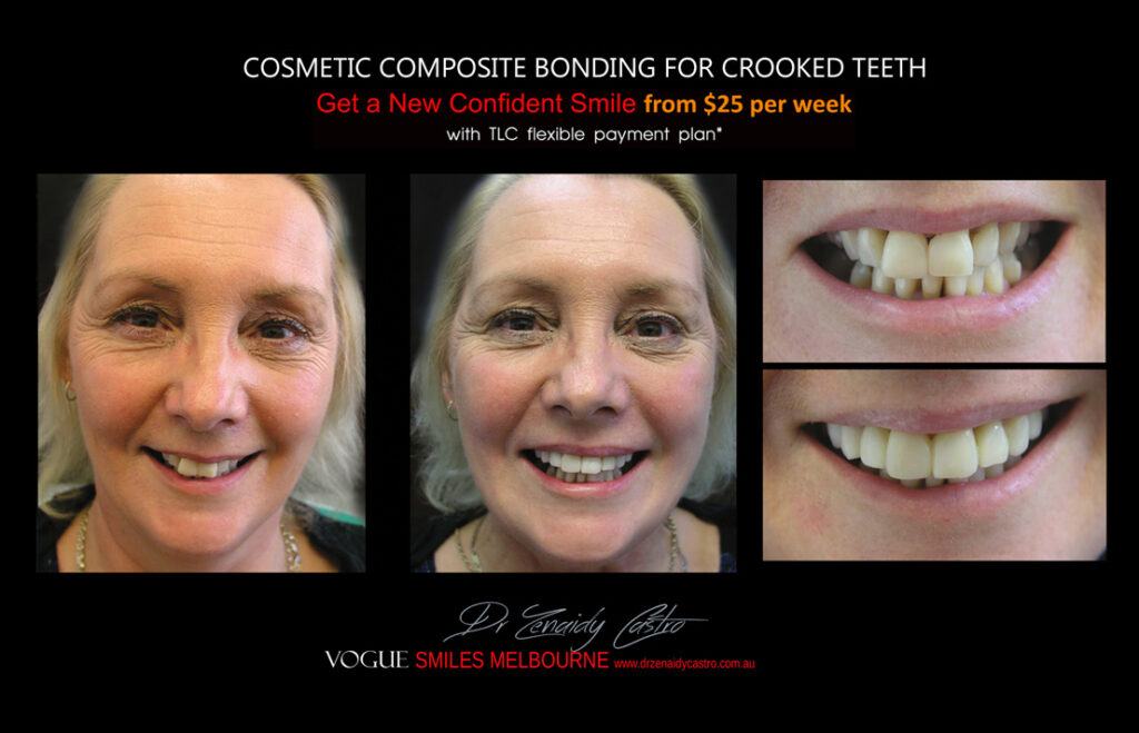 Affordable-Cheap-Cosmetic-Smile-Makeover