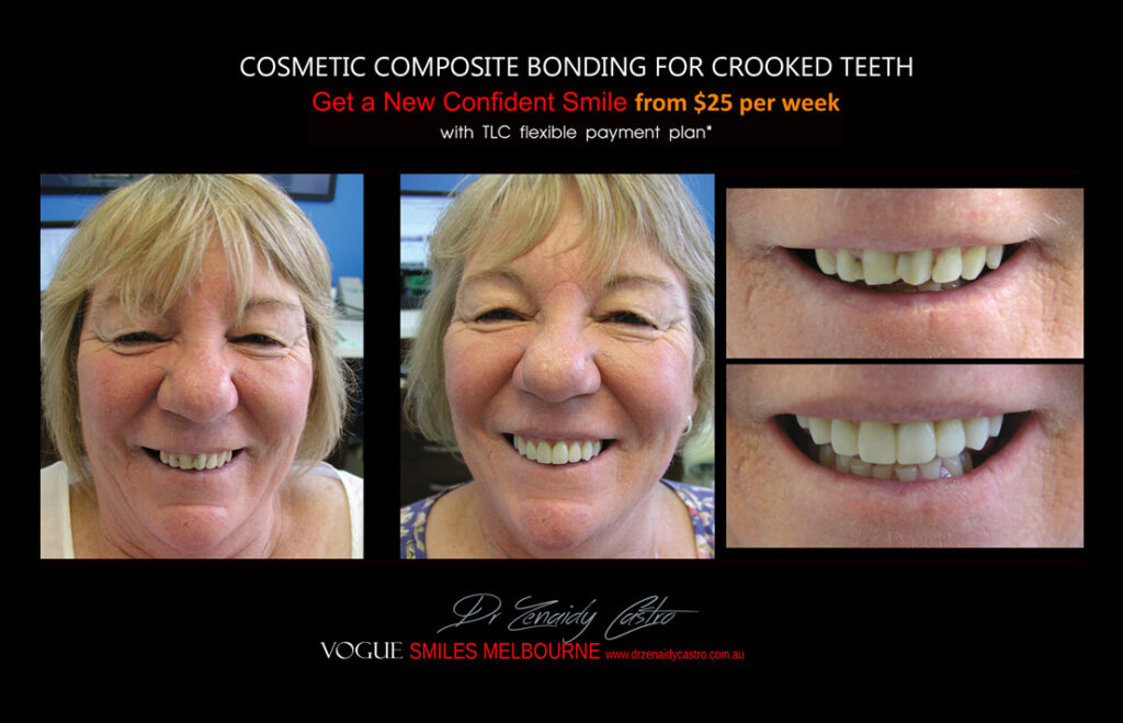 Affordable-Cheap-Cosmetic-Smile-Makeover