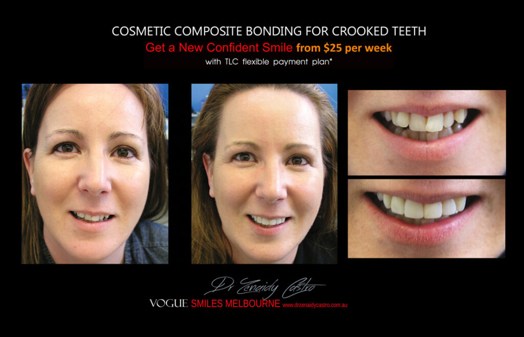 Affordable-Cheap-Cosmetic-Smile-Makeover