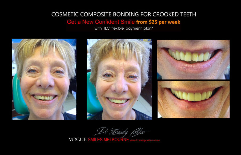 Affordable-Cheap-Cosmetic-Smile-Makeover