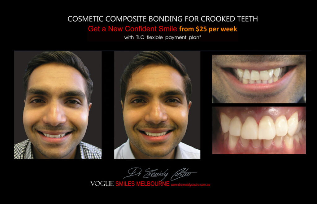 Affordable-Cheap-Cosmetic-Smile-Makeover