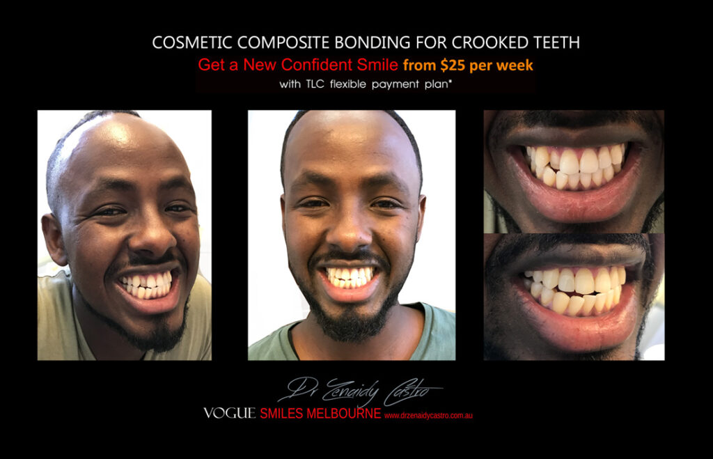 Affordable-Cheap-Cosmetic-Smile-Makeover